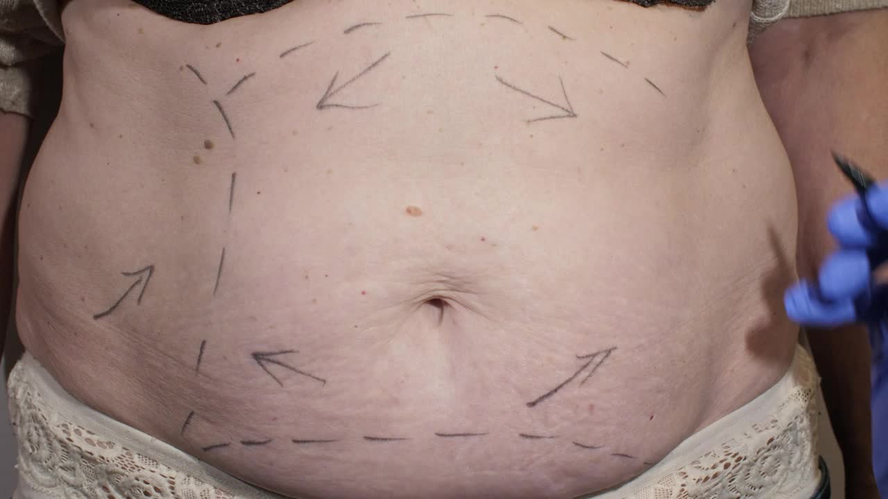 Stock Video Marking Abdomen Before Liposuction Surger Animated Wallpaper