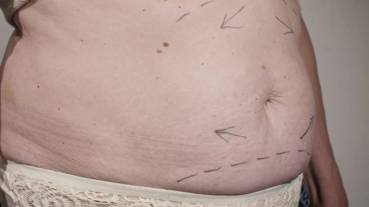 Stock Video Marking A Womans Abdomen Before Liposuctio Animated Wallpaper