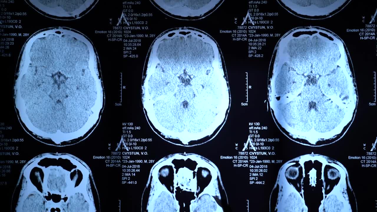 Free Video Stock Skull X Rays View Live Wallpaper