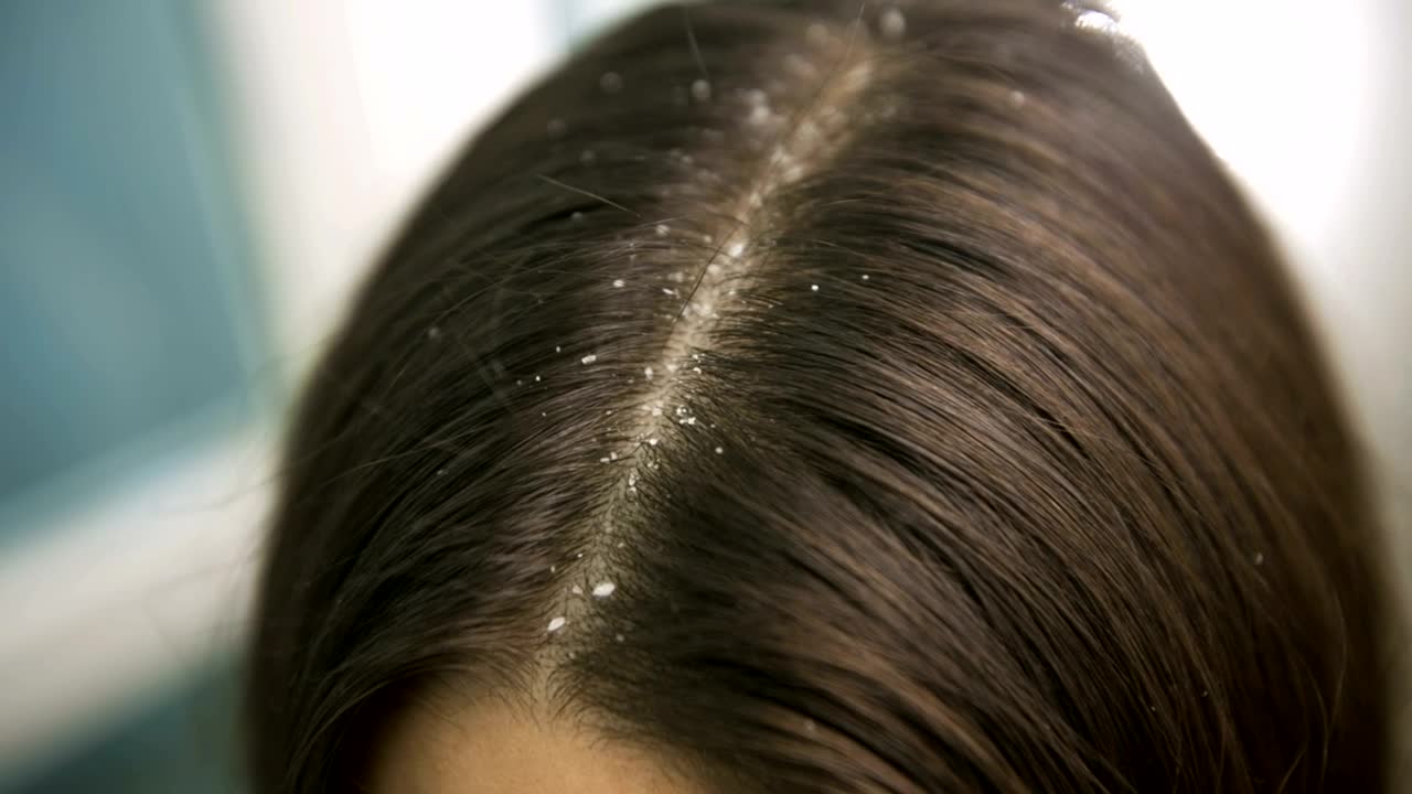 Free Stock Video Woman With Dandruff In Hair Close Up Live Wallpaper
