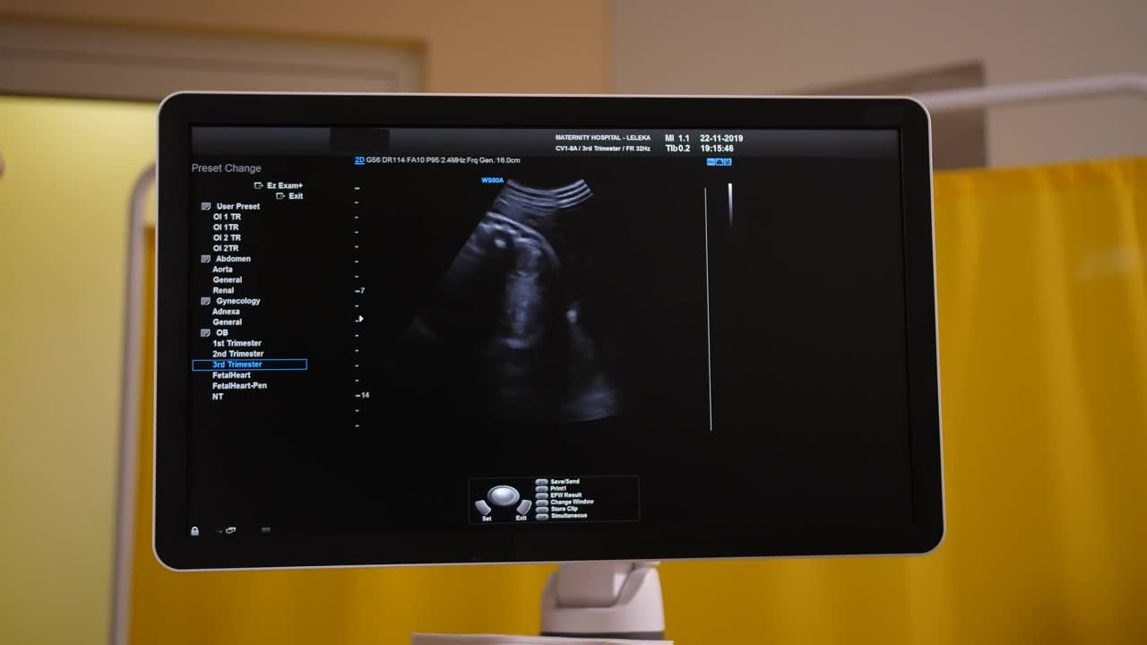   Stock Footage Ultrasound Scan On A Monitor Live Wallpaper